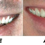 Before and after picture of teeth whitening