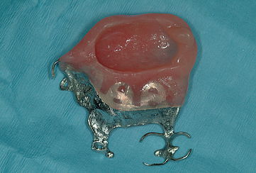 Example of Maxillofacial Prosthetics